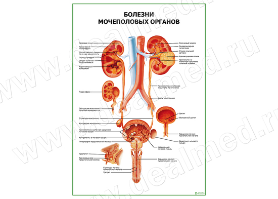 Болезни мочеполовых органов плакат матовый/ламинированный А1/А2