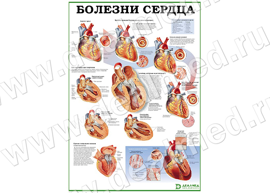 Болезни сердца, плакат матовый/ламинированный А1/А2