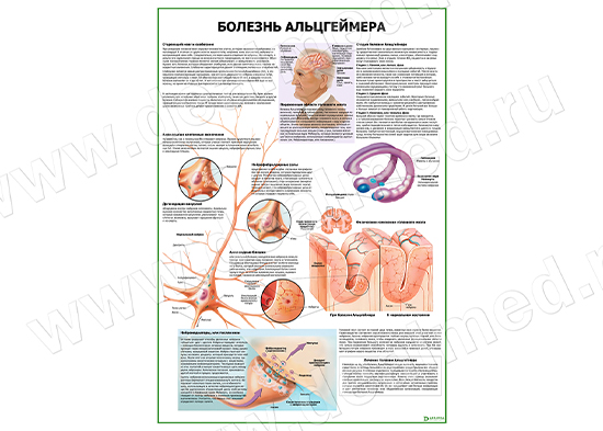  Болезнь Альцгеймера плакат матовый/ламинированный А1/А2 