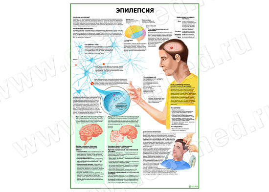  Эпилепсия плакат матовый/ламинированный А1/А2 