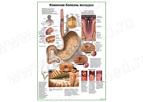  Язвенная болезнь желудка плакат матовый/ламинированный А1/А2 