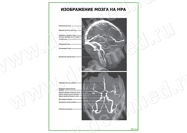  Изображение мозга на МРА плакат матовый/ламинированный А1/А2 