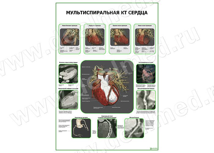  Мультиспиральная КТ Сердца плакат глянцевый/ламинированный А1/А2 