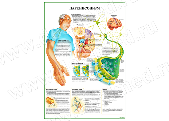  Паркинсонизм плакат глянцевый/ламинированный А1/А2 