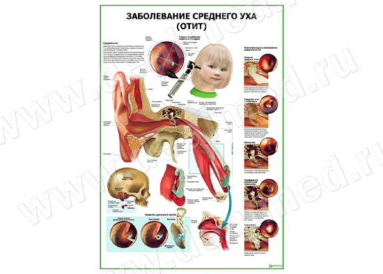 Заболевания среднего уха (отит) плакат матовый/ламинированный А1/А2 