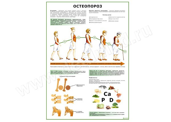  Остеопороз плакат матовый/ламинированный А1/А2 