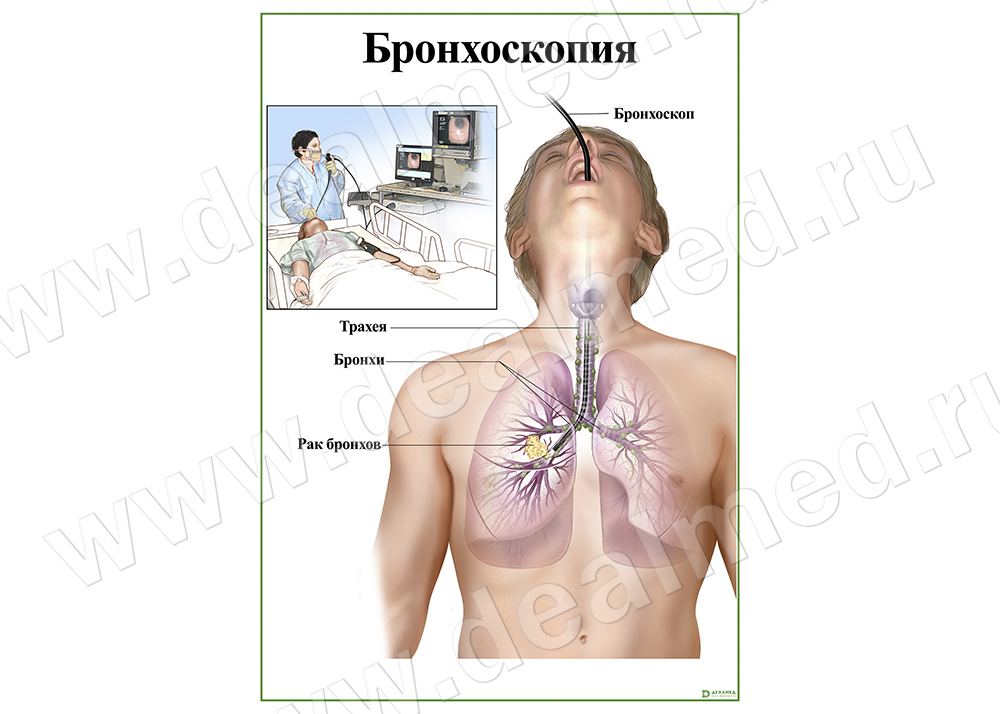 Бронхоскопия, плакат глянцевый/ламинированный А1/А2