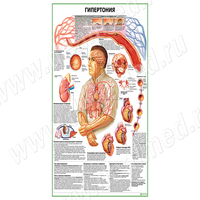 Гипертония плакат матовый/ламинированный А1/А2