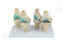Анатомическая модель коленного сустава с патологиями