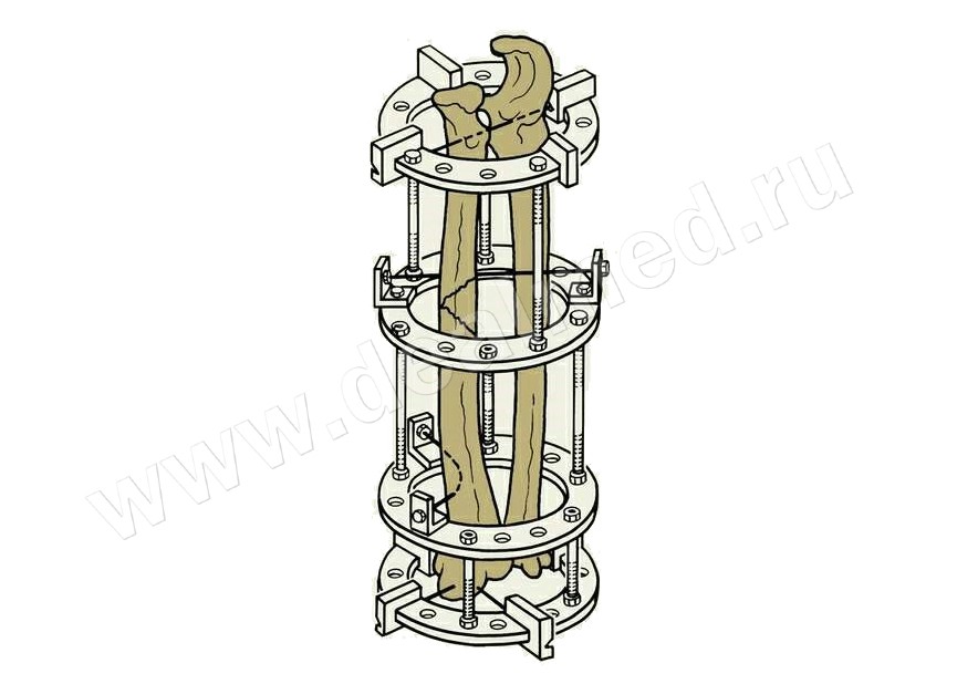  деталей аппарата Илизарова для бедра, Россия › , цена в .