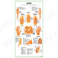Артрит плакат матовый/ламинированный А1/А2