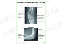 Рентгенография локтевого сустава плакат матовый/ламинированный А1/А2
